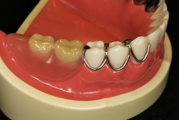 ゆう歯科クリニック・欠損補綴